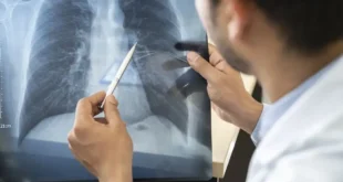 Anvisa aprova novo medicamento para câncer de pulmão avançado