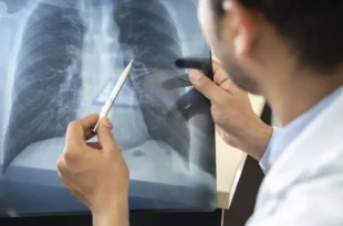 Anvisa aprova novo medicamento para tratamento de câncer de pulmão avançado